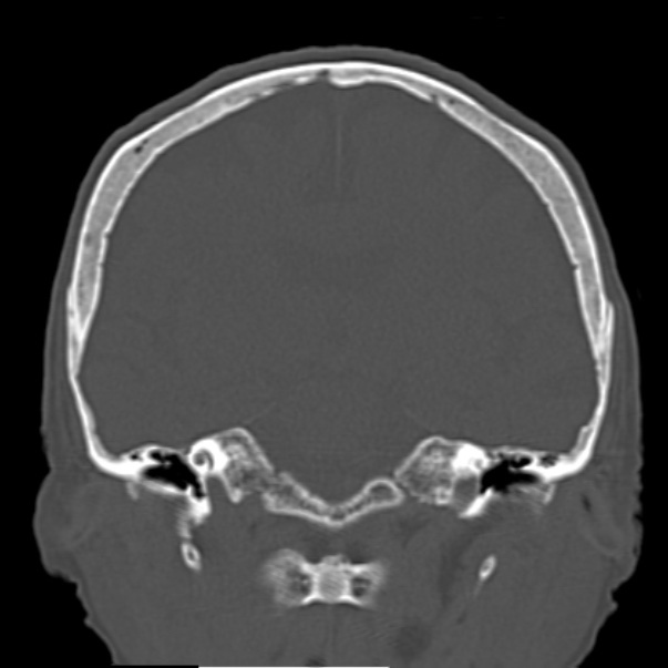 Biparietal osteodystrophy (Radiopaedia 46109-50463 Coronal bone window 58).jpg