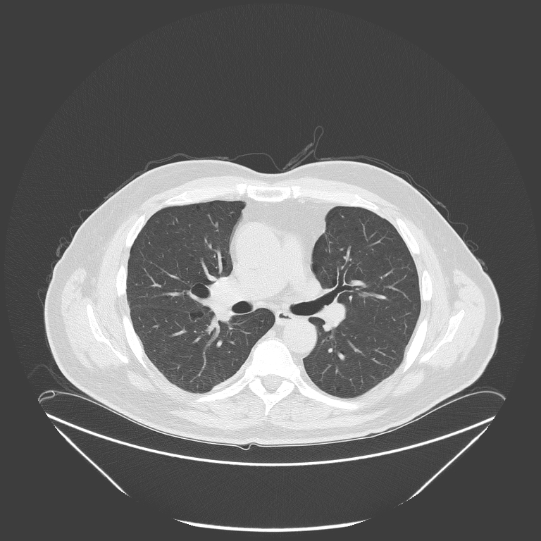 Birt-Hogg-Dubé syndrome (Radiopaedia 52578-58491 Axial lung window 28).jpg
