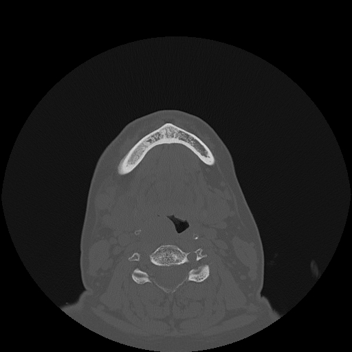 File:Bisphosphonate-related osteonecrosis of the jaw (Radiopaedia 71324-81642 Axial bone window 26).jpg