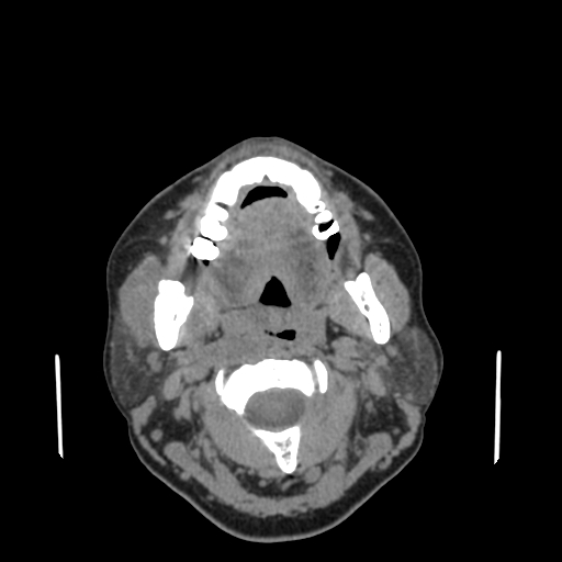 Bisphosphonate-related osteonecrosis of the jaw (Radiopaedia 71324-81642 non-contrast 91).jpg