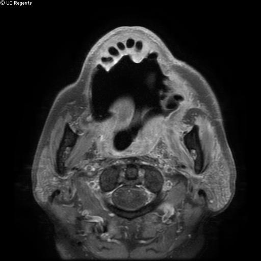 Bisphosphonate-related osteonecrosis of the maxilla (Radiopaedia 51367-57101 Axial T1 C+ fat sat 15).jpg