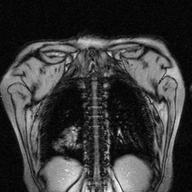File:Black-border MRI artifact (Radiopaedia 21765).jpg