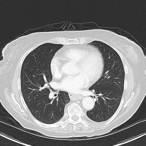 File:Bladder and bowel cancers (Radiopaedia 37688-39592 Axial lung window 31).png