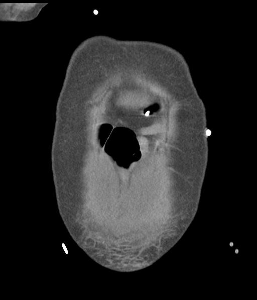 Bladder rupture post renal biopsy (Radiopaedia 30863-31572 Coronal non-contrast 9).jpg