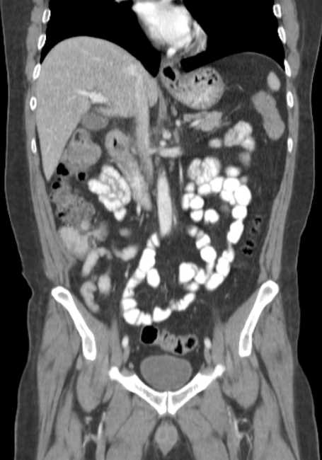 Bleeding duodenal ulcer and adenomyomatosis of gallbladder (Radiopaedia 61834-69861 B 45).jpg