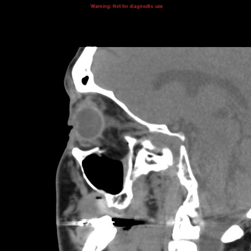 File:Blowout fracture with inferior rectus entrapment (Radiopaedia 12418-12673 C 11).jpg