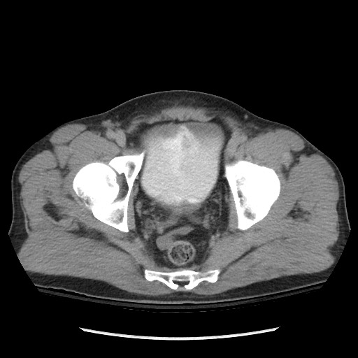 File:Blunt abdominal trauma with solid organ and musculoskelatal injury with active extravasation (Radiopaedia 68364-77895 Axial C+ delayed 126).jpg