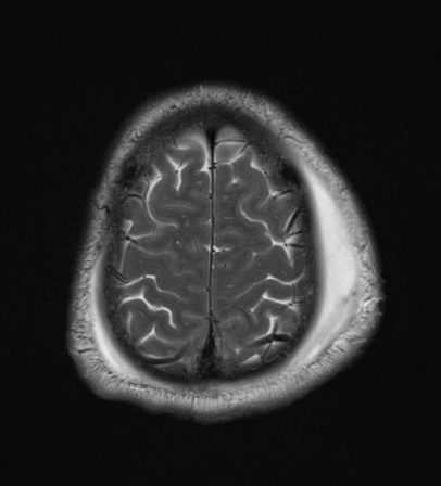 File:Blunt cerebrovascular injury (Radiopaedia 53682-59745 Axial T2 26).png