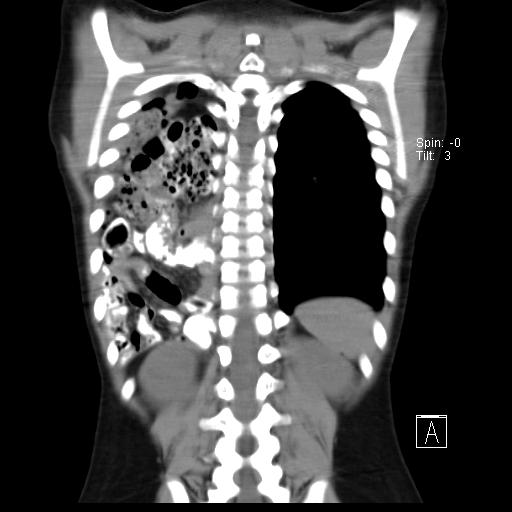File:Bochdalek diaphragmatic hernia (Radiopaedia 38866-41059 Coronal liver window 17).jpg