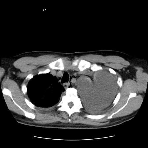 Boerhaave syndrome (Radiopaedia 59796-67310 Axial liver window 16).jpg