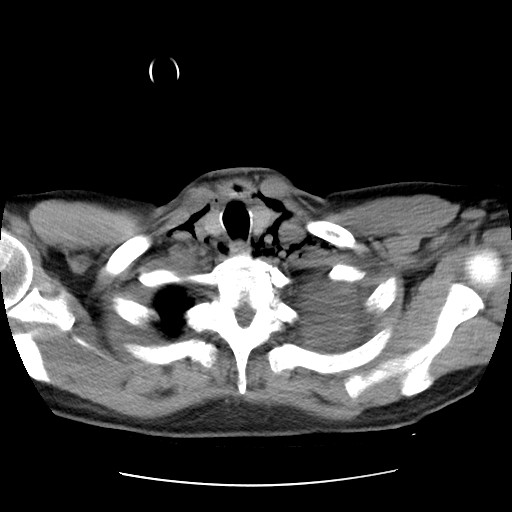 File:Boerhaave syndrome (Radiopaedia 59796-67310 Axial liver window 9).jpg