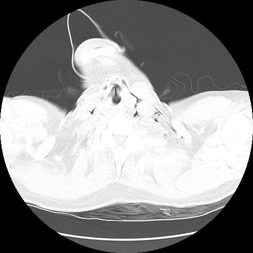 Boerhaave syndrome (Radiopaedia 59796-67310 Axial lung window 5).jpg