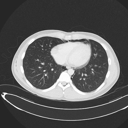 File:Boerhaave syndrome with mediastinal, axillary, neck and epidural free gas (Radiopaedia 41297-44115 Axial lung window 62).jpg
