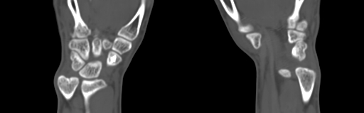 Bone islands - carpus (Radiopaedia 63141-71658 Coronal bone window 49).jpg