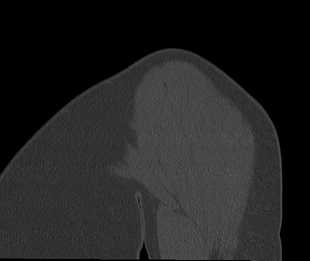 Bony Bankart and Hill-Sachs lesions (Radiopaedia 33622-34727 Sagittal bone window 9).png
