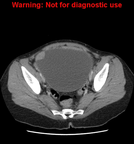 Borderline mucinous cystadenoma of ovary (Radiopaedia 25586-25767 A 94).jpg