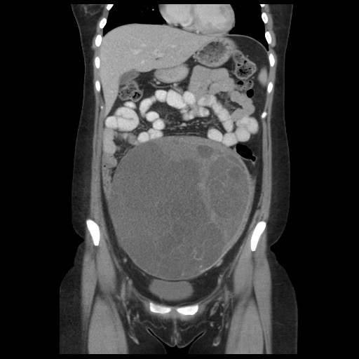 Borderline mucinous tumor (ovary) (Radiopaedia 78228-90808 C 20).jpg