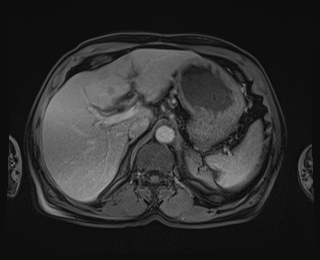 Bouveret syndrome (Radiopaedia 61017-68856 Axial T1 C+ fat sat 23).jpg