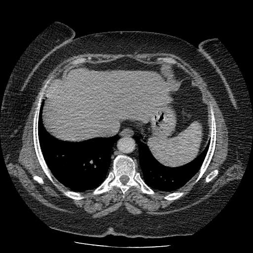 Bovine aortic arch - right internal mammary vein drains into the superior vena cava (Radiopaedia 63296-71875 A 133).jpg
