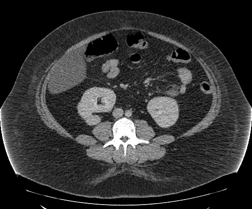 Bowel and splenic infarcts in acute lymphocytic leukemia (Radiopaedia 61055-68913 A 72).jpg