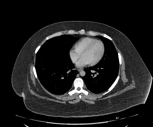 Bowel and splenic infarcts in acute lymphocytic leukemia (Radiopaedia 61055-68913 A 9).jpg