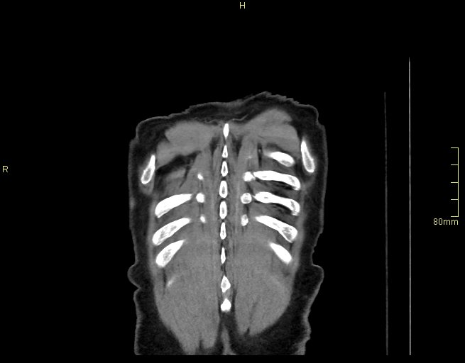 Brachial artery foreign body (Radiopaedia 54583-60820 Coronal non-contrast 58).jpg