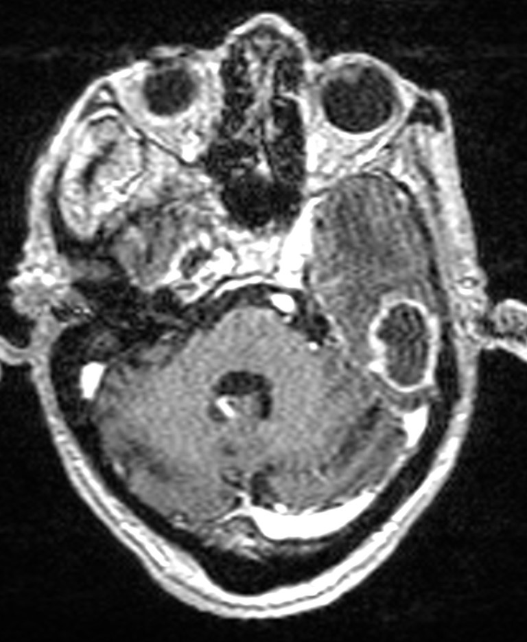 Brain abscess with dual rim sign (Radiopaedia 87566-103938 Axial T1 C+ 48).jpg