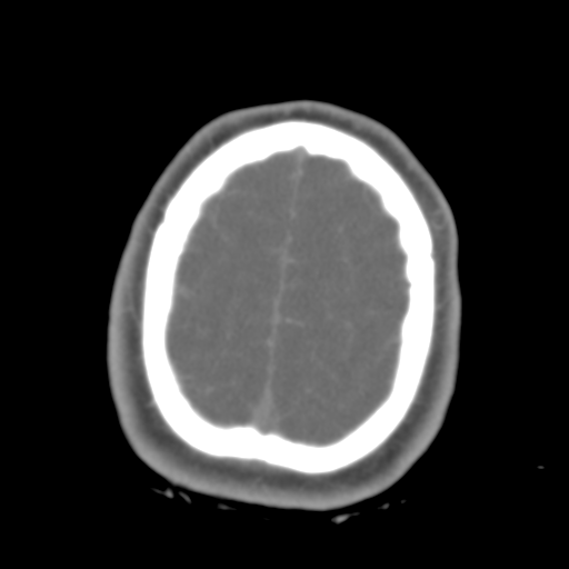 Brain contusions, internal carotid artery dissection and base of skull fracture (Radiopaedia 34089-35339 D 9).png