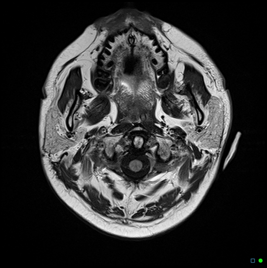 File:Brain death on MRI and CT angiography (Radiopaedia 42560-45689 Axial FLAIR 1).jpg