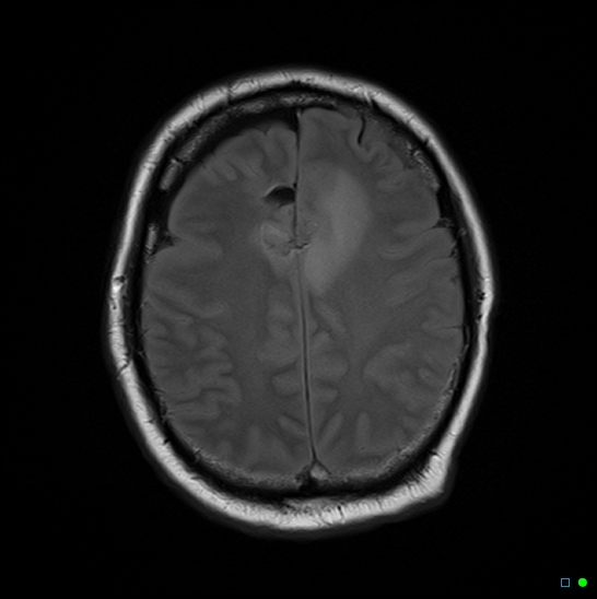 File:Brain death on MRI and CT angiography (Radiopaedia 42560-45689 Axial FLAIR 12).jpg