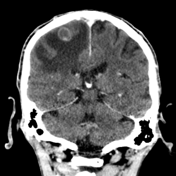 Brain metastases from lung cancer (Radiopaedia 27849-28092 Coronal C+ delayed 42).jpg