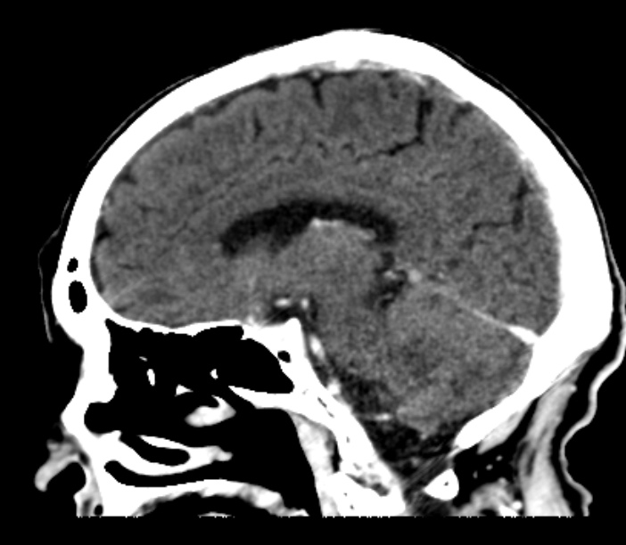 Brain metastases from lung cancer (Radiopaedia 27849-28092 Sagittal C+ delayed 35).jpg