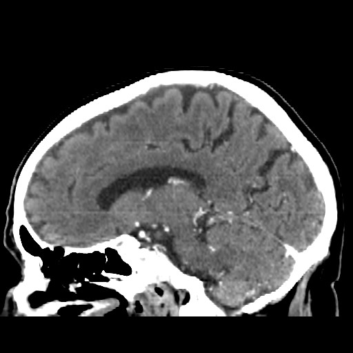 Brain metastasis (Radiopaedia 42617-45760 D 22).jpg