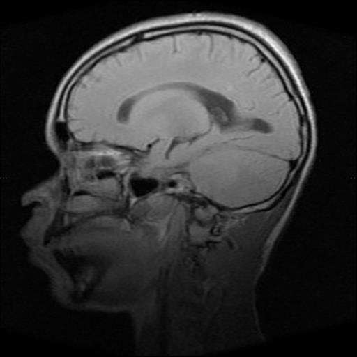 File:Brainstem glioma (Radiopaedia 30923-31624 Sagittal T1 12).jpg