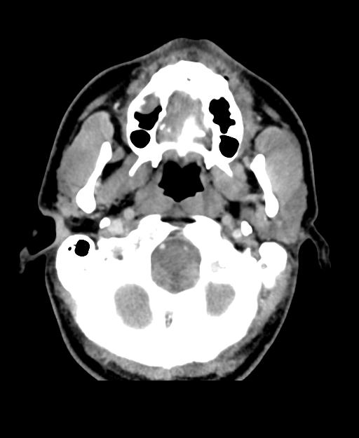 Branchial cleft cyst (Radiopaedia 31167-31875 Axial C+ delayed 8).jpg