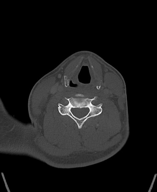 Branchial cleft cyst (Radiopaedia 31167-31875 Axial bone window 45).jpg