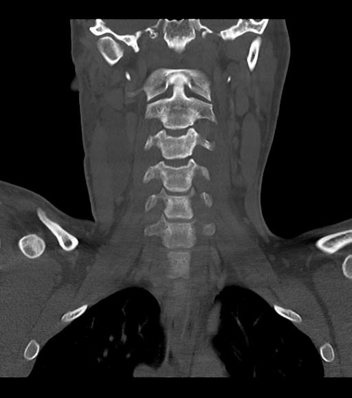 Branchial cleft cyst (Radiopaedia 31167-31875 Coronal bone window 37).jpg