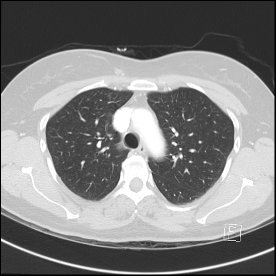 Breast metastases from renal cell cancer (Radiopaedia 79220-92225 Axial lung window 24).jpg