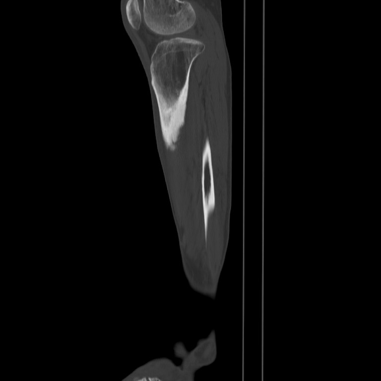 Brodie abscess - tibia (Radiopaedia 66028-75204 Sagittal bone window 58).jpg