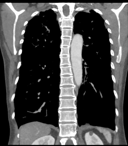 File:Bronchial artery aneurysms (Radiopaedia 42282-45385 Coronal C+ delayed 47).png