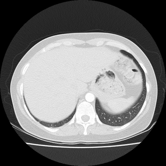 Bronchial atresia (Radiopaedia 22965-22992 Axial lung window 9).jpg