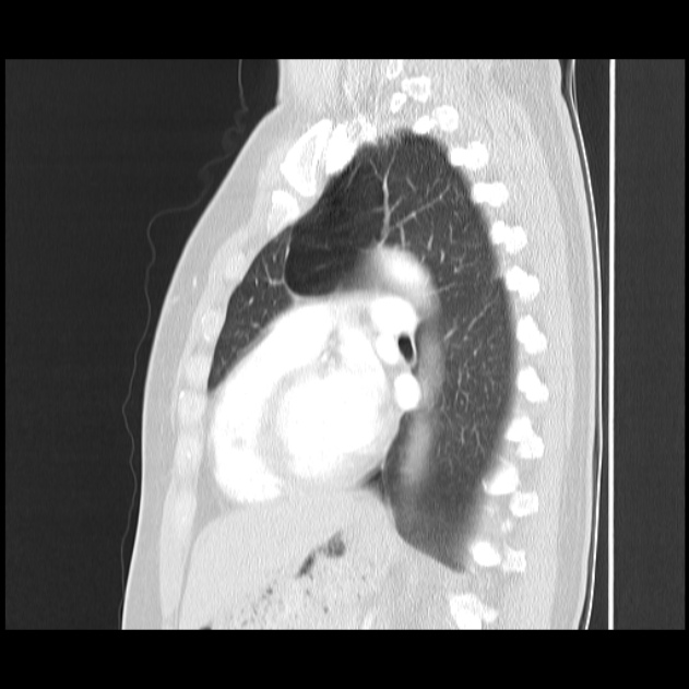 Bronchial atresia (Radiopaedia 22965-22992 Sagittal lung window 23).jpg