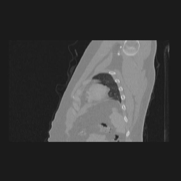 Bronchial atresia (Radiopaedia 60685-68439 Sagittal lung window 85).jpg