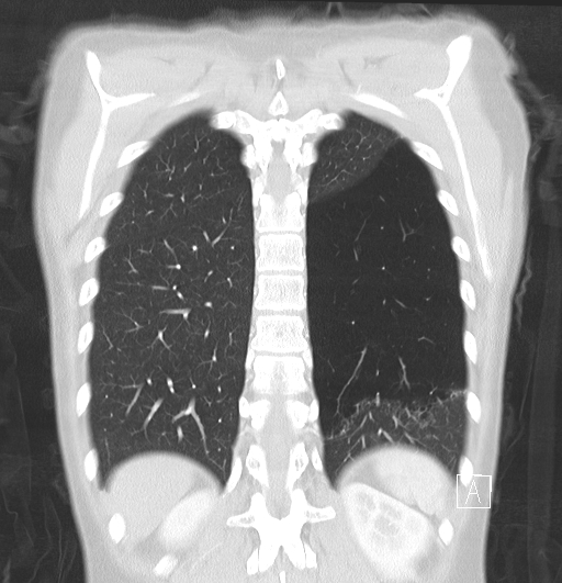 File:Bronchial atresia (Radiopaedia 73677-84470 Coronal lung window 28).jpg