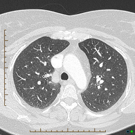 File:Bronchial diverticula (Radiopaedia 79512-92676 Axial lung window 55).jpg