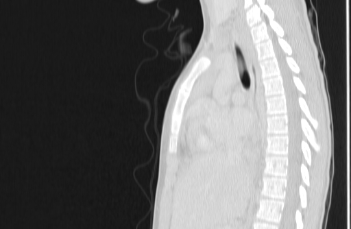 Bronchial mucoepidermoid carcinoma (Radiopaedia 57023-63895 Sagittal lung window 82).jpg