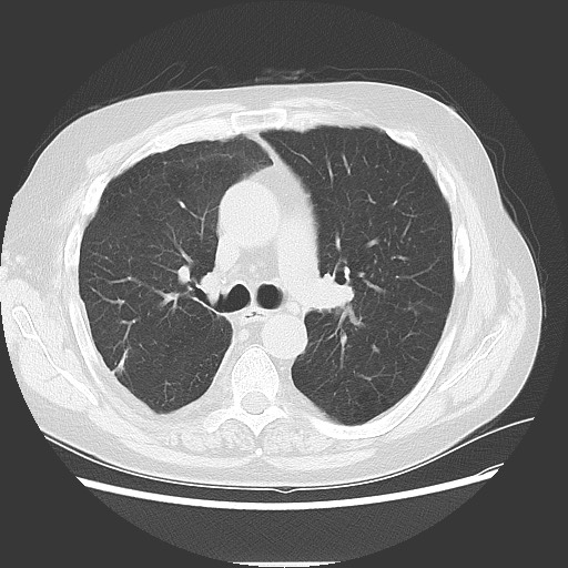 Bronchial stenosis - lung transplant (Radiopaedia 73133-83848 Axial lung window 27).jpg