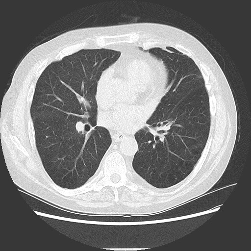 Bronchial stenosis - lung transplant (Radiopaedia 73133-83848 Axial lung window 36).jpg