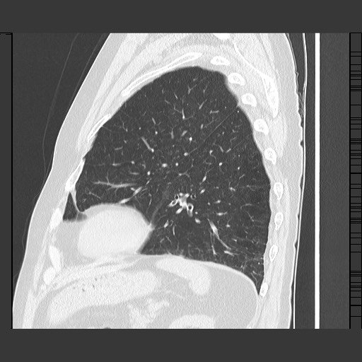 Bronchial stenosis - lung transplant (Radiopaedia 73133-83848 Sagittal lung window 52).jpg