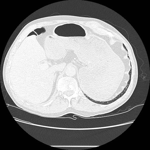 File:Bronchocele (Radiopaedia 17097-16795 Axial lung window 112).jpg